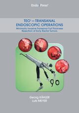 TEO® – Transanal Endoscopic Operations. Minimally Invasive Transanal Full Thickness Resection of Early Rectal Tumors