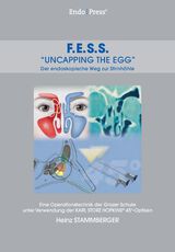FESS – „Uncapping the Egg“ – Der endoskopische Weg zur Stirnhöhle