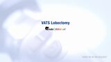 VATS Lobectomy