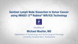 Sentinel Lymph Node Dissection in Vulvar Cancer using IMAGE1 S™ Rubina® NIR/ICG Technology