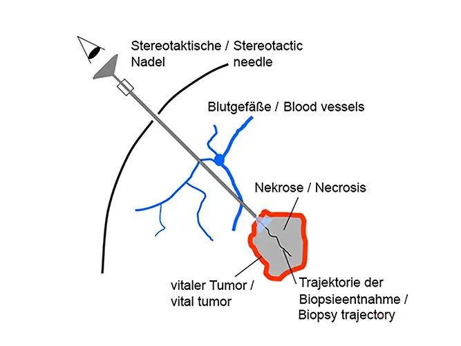 Diagrama de una aguja estereotáctica para biopsia, mostrando vasos sanguíneos, necrosis y tumor vital.
