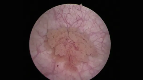 Close-up of a bladder wall with visible veins and a papillary tumor under a cystoscope.