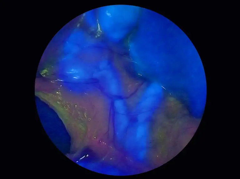 ICG (indocyanine green) fluorescence in HD Quality.