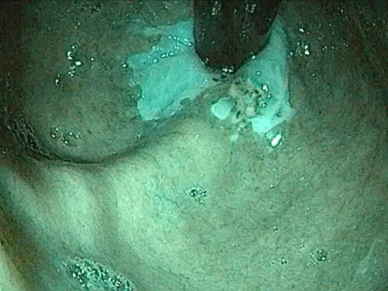 High-definition video endoscopes for gastroenterology are equipped with an innovative visualization system that provides a white light mode as well as three defined spectral ranges for specific applications.