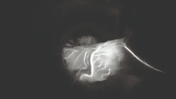 Medical X-ray image showing highlighted veins or blood vessels in a human body region.