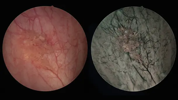 Endoscopic images of bladder tumor under different imaging modes.