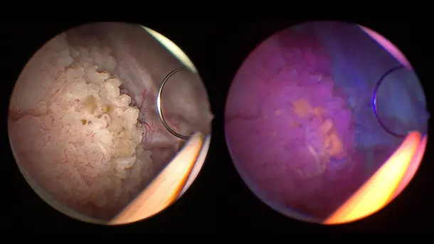 Endoscopic view of bladder cancer tumor under white and blue light during cystoscopy.