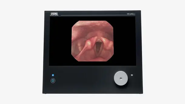 Endoscopic image of human vocal cords displayed on a medical monitor.