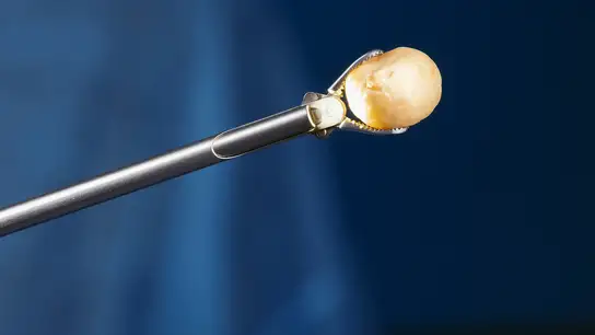 Dental extraction forceps holding a human tooth.